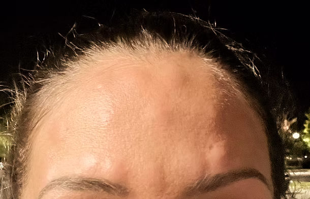 Botox Bumps