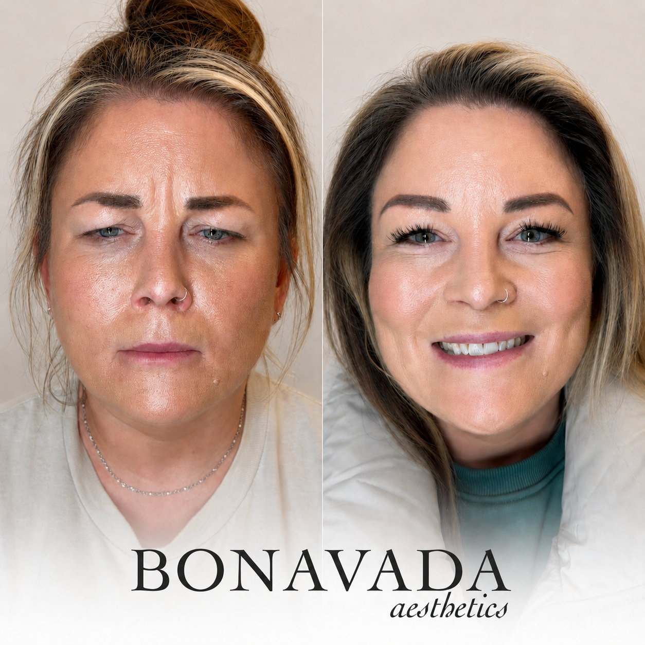 Botox BONAVADA Aesthetics
