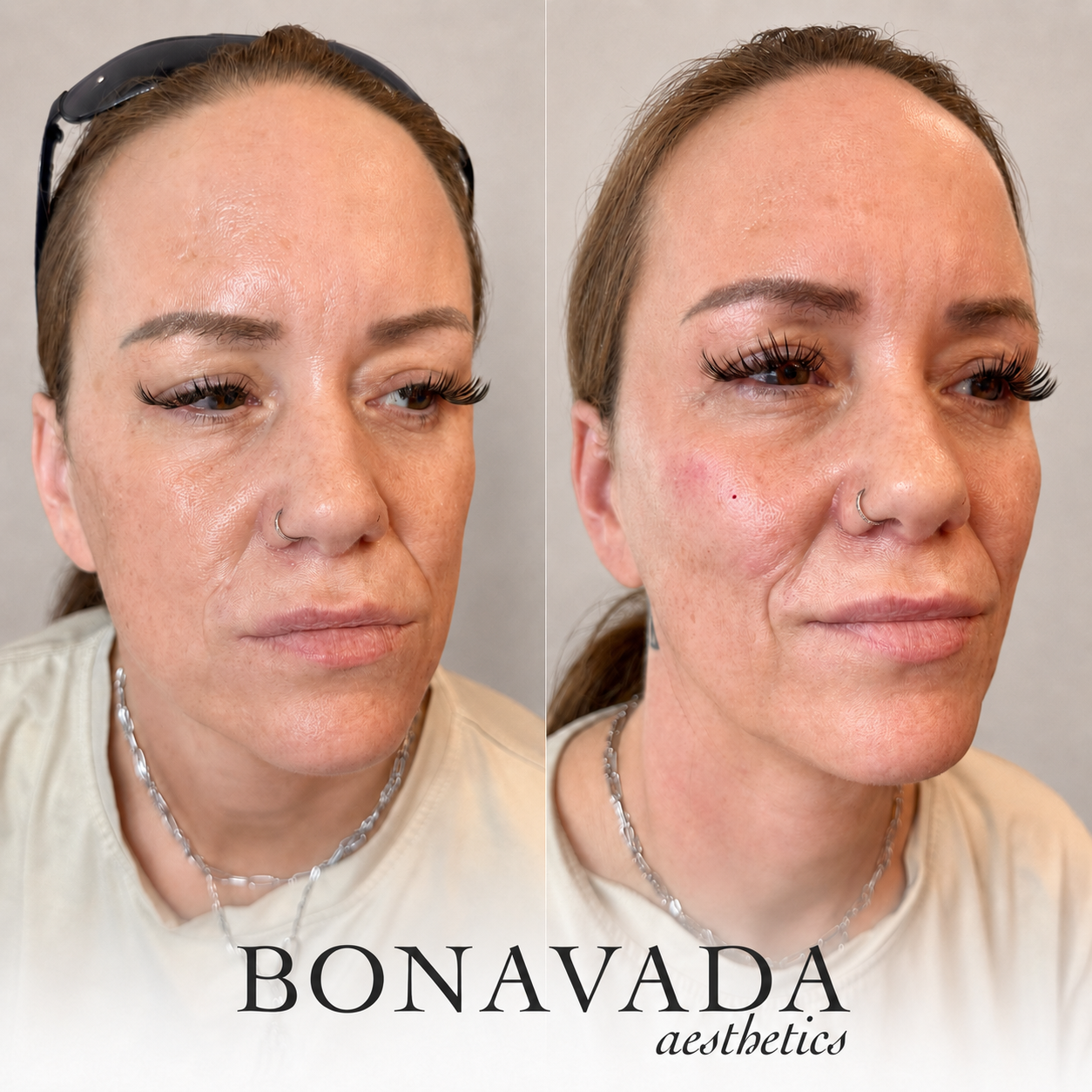 Dermal Filler BONAVADA Aesthetics