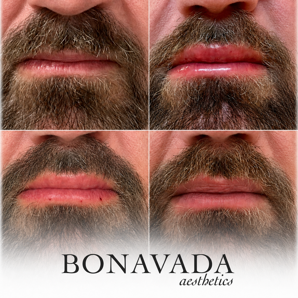 Lip Booster BONAVADA Aesthetics