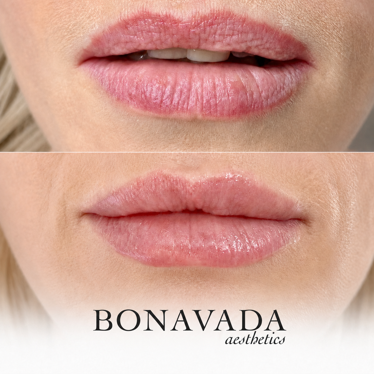 Lip Filler BONAVADA Aesthetics