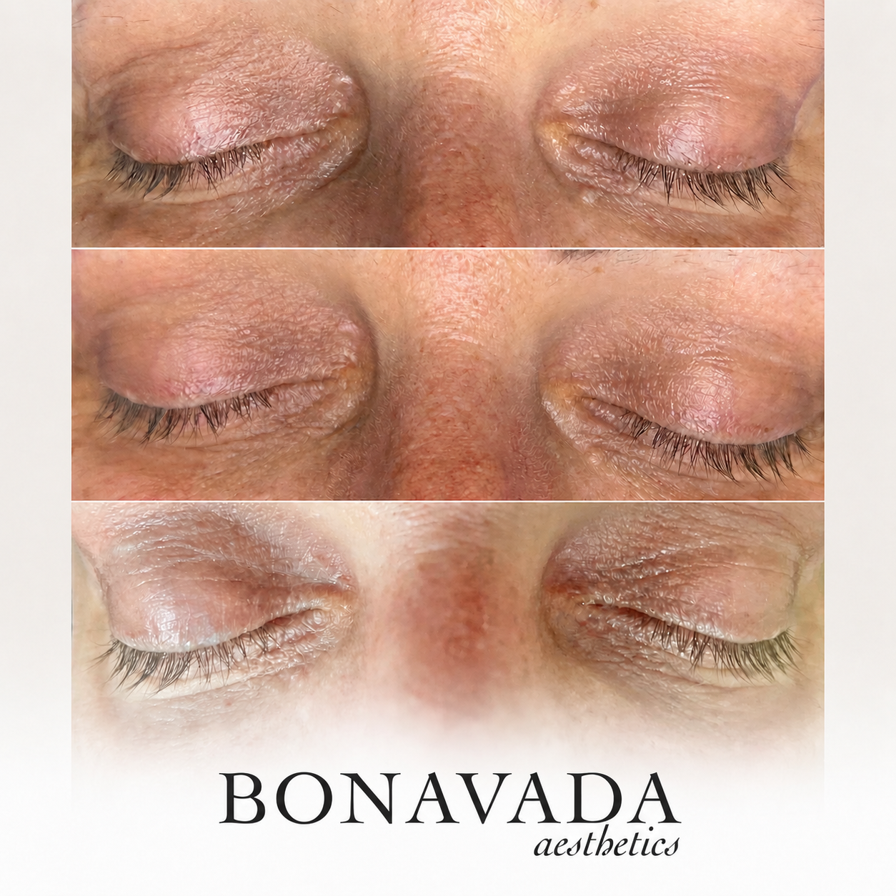 Milia Removal BONAVADA Aesthetics